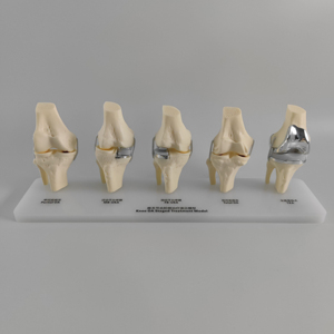 Modèle de comparaison d'implants totaux unicompartimentaux pour l'<span class=keywords><strong>arthrose</strong></span> du genou à 5 stades, modèle de traitement progressif - Product Image 4