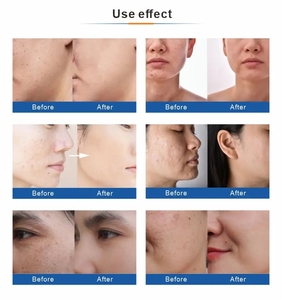 2025 New Hidro Oxygen Jet Skin Rejuvenation Aqua Water Peel Machine 5 in 1 Skin Micro Hidradermabrasion Beauty Machine - Product Image 5