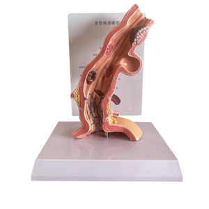 Modelo Anatómico de Enfermedad Patológica del Esófago KyrenMed, Modelo de Polipo Esofágico con <span class=keywords><strong>Erosión</strong></span>, Ampliado 5 Veces - Product Image 1