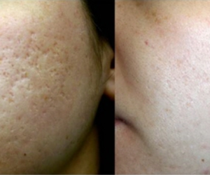 Machine de resurfaçage de la peau au laser Co2 fractionnaire haute puissance populaire équipement de beauté enlèvement des cicatrices et traitement esthétique - Product Image 6