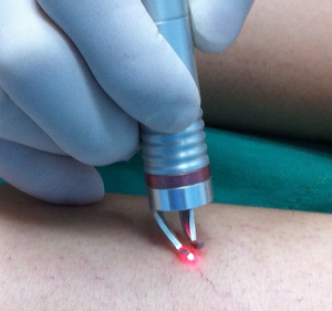 30W EVLT EVLA 980nm 1470nm Terapia de <span class=keywords><strong>luz</strong></span> roja Vaso sanguíneo Eliminación de venas varicosas Máquina quirúrgica láser endovenosa - Product Image 3