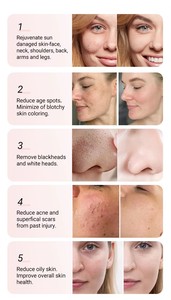 Venta Directa de Microdermoabrasión con Oxígeno y Punta de Diamante, Limpieza Profunda de la Piel, Rejuvenecimiento Cutáneo, Super Bubble Hydroo Aqua Facial - Product Image 6