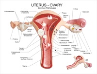 Modelo de Útero Femenino para Patología, Anatomía Médica, para Médicos y Estudiantes