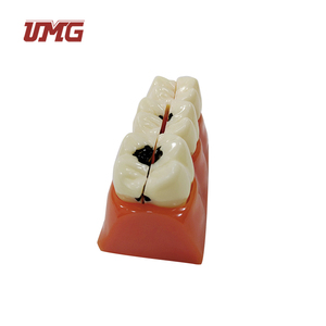 Modelo educativo de ciencia médica, modelo de desmontaje de caries de tamaño 4 veces - Product Image 5