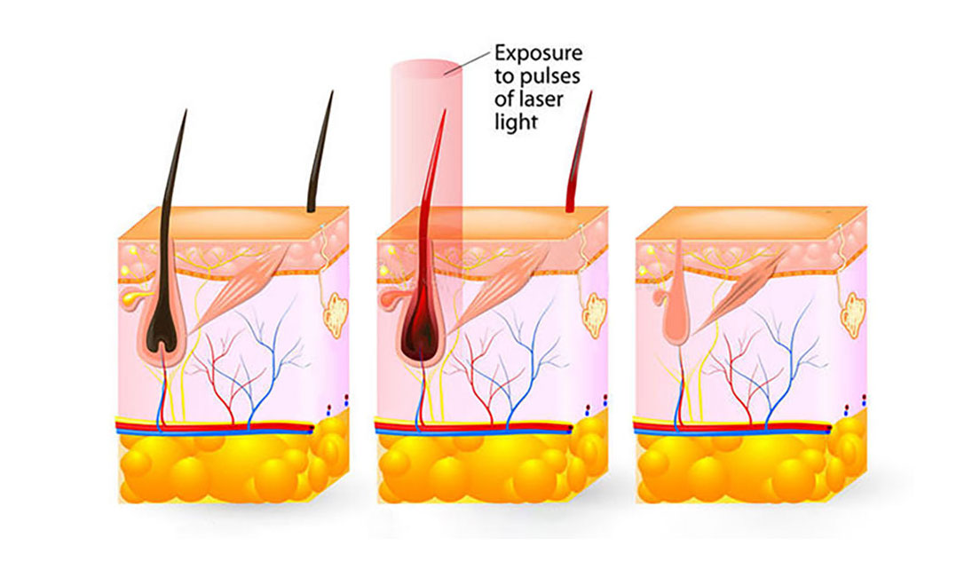2023 new cooling technology 808 diode laser hair removal for hair loss treatment diodo laser depilacion