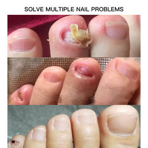 Patch pour ongles en gel hydrocolloïde protecteur pour prévenir la <span class=keywords><strong>casse</strong></span> et favoriser la récupération des ongles - Product Image 3