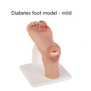 Modelo de pie diabético (leve/grave) para entrenamiento médico y educación - Product Image 2