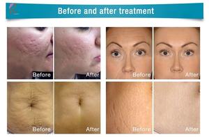 <span class=keywords><strong>Prix</strong></span> usine 2026 – Appareil de <span class=keywords><strong>microneedling</strong></span> RF 2-en-1 et machine de rajeunissement cutané RF fractionné pour les cicatrices d'acné - Product Image 6