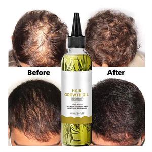 Aceite de Romero Natural para el Crecimiento del Cabello, con Logo Personalizable, Aceite Herbal para el Cuero Cabelludo, Fortalece el Cabello y Previene la Caída - Product Image 4