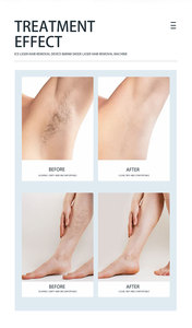 Mới nhất YingCai thiết kế độc đáo chuyên nghiệp 3 bước sóng Diode Máy tẩy lông bằng laser năng lượng mạnh mẽ và năng lượng 808 Diode Laser - Product Image 6