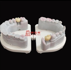 ส่วนบนของฟันเทียมไทเทเนียมพิมพ์ดิจิตอล3D แบบกำหนดเองเหมาะสำหรับระบบฝังหลัก - Product Image 4