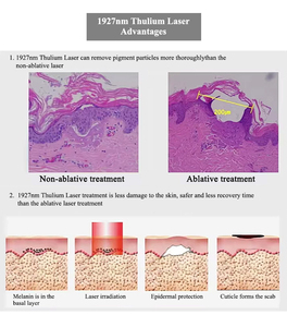 Dispositivo Láser de Cuidado de la Piel de 1927nm, Popular en 2026, con Material ABS, Reduce las Líneas Finas y las Arrugas, para Uso en Spa - Product Image 4