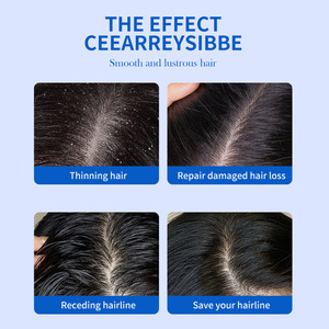 Shampoo e Balsamo Antiforfora a Pulizia Profonda con <span class=keywords><strong>Solfuro</strong></span> <span class=keywords><strong>di</strong></span> <span class=keywords><strong>Selenio</strong></span> per Tutti i Tipi <span class=keywords><strong>di</strong></span> Capelli - Cura del Cuoio Capelluto, Sollievo dalla Forfora, Nutriente - Product Image 3