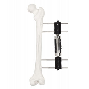 <span class=keywords><strong>Fixator</strong></span> eksternal dinamis Axial eksternal <span class=keywords><strong>Fixator</strong></span> sendi kaki tipe sistem fiksasi eksternal - Product Image 3
