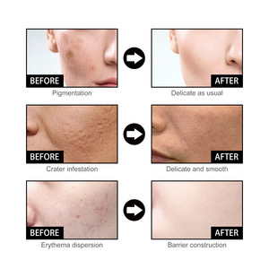 Suero Facial con Niacinamida EELHOE, Desvanece Marcas de Acné, Hidrata y Humecta, Reduce los Poros, Blanquea y Embellece la Piel, 50 ml - Product Image 3