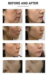 Dispositivo de Belleza de Última Generación 2026, Doble Longitud de Onda 1927nm Tulio 1550nm Erbio, Fibra Fraccionada No Ablativa <span class=keywords><strong>para</strong></span> Rejuvenecimiento Vaginal, con Certificación CE - Product Image 6