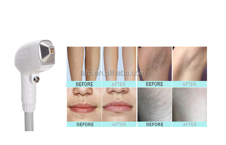 NEW design! 4 in 1 opt IPL+ 808nm diode laser + rf +nd yag laser beauty salon equipment ipl laser hair removal machine