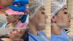 Máquina <span class=keywords><strong>de</strong></span> Láser Diodo para Endolifting Facial <span class=keywords><strong>de</strong></span> 980nm, Tensado <span class=keywords><strong>de</strong></span> <span class=keywords><strong>Piel</strong></span>, Lipo, Papada, Quema <span class=keywords><strong>de</strong></span> Grasa, Lipólisis, Estiramiento Facial, Endolifting, Endoláser - Product Image 6