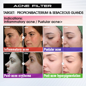 Máquina Antienvejecimiento BBL <span class=keywords><strong>Plus</strong></span> de Nivel Médico, Dispositivo Reafirmante Antiarrugas para Cuello, Rostro y Cuerpo Completo - Product Image 5