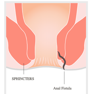 Macchina Laser a Diodi 1470nm per il Taglio di Emorroidi e Fistole Anali - Product Image 6