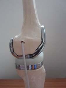 Hoogwaardig PVC afneembaar kunstmatig klein dubbel zilveren kniegewricht implantaat modelset medisch wetenschappelijk oefenmodel voor protheses - Product Image 5