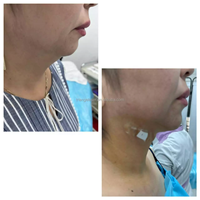 Liposuccion Vaser, lifting endolaser, laser diode 980 nm, appareil laser à fibre, resserrement cutané, lifting endolaser