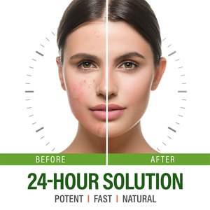 Etiqueta privada OEM Eliminación rápida y eficaz del logotipo Manchas de acné a base de hierbas Control de aceite Manchas Elimina las espinillas Crema facial con ácido salicílico BHA - Product Image 2