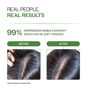 <span class=keywords><strong>Shampoo</strong></span> Antiforfora con Formula Medicata Antifungina per <span class=keywords><strong>Dermatite</strong></span> Seborroica e Follicolite - Sollievo per <span class=keywords><strong>Cuoio</strong></span> <span class=keywords><strong>Capelluto</strong></span> Pruriginoso, Squamoso e Grasso - Product Image 4