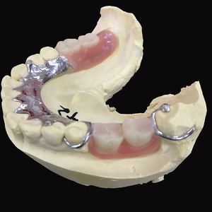 Cadre en alliage Cocr pour prothèses partielles avec base en résine dents acryliques prothèses amovibles en laboratoire dentaire en chine - Product Image 1