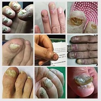 Sérum de Traitement Rapide des Mycoses des Ongles en 7 Jours OEM ODM, Huile Réparatrice pour Ongles Abîmés Marque Privée, Sérum Original pour la Croissance des Ongles