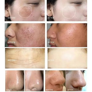 เครื่องพ่นออกซิเจนแบบพกพา Black Pearl 10 in 1 Aqua Peel สำหรับทำความสะอาดผิวหน้าอย่างล้ำลึก พร้อมระบบดูดสิวเสี้ยนและขัดผิวด้วยเพชร - Product Image 6