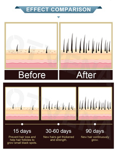 น้ำมันบำรุงผมขิง 100% ช่วยเร่งผมยาวเห็นผลในปี 2023 ป้องกันผมร่วง - Product Image 3