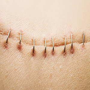 Cucitrice cutanea monouso con chiusura a ferita medica 35W e rimozione di graffette chirurgiche - Product Image 5