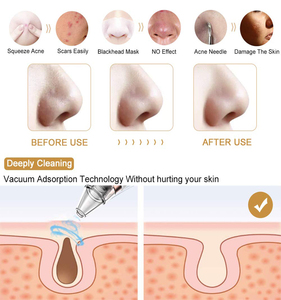 Limpiador de poros Facial portátil, dispositivo eléctrico de succión de espinillas, succión de poros faciales al vacío, removedor de acné y espinillas, 2021 - Product Image 2