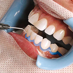 Clínica Branqueamento Dentes Whitening Gum Protector Dentista Usando Azul Gengival Gum Barreira Gel - Product Image 4