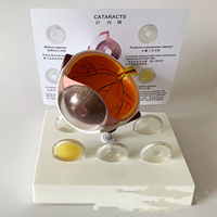 Modèle d'anatomie de l'œil pour la cataracte, démonstration de l'opacité de la lentille, enseignement médical, optique, modèle d'anatomie humaine