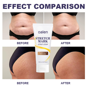 Crème <span class=keywords><strong>anti</strong></span>-<span class=keywords><strong>vergetures</strong></span> efficace pour l'élimination des cicatrices d'acné et de boutons, lotion réparatrice raffermissante et lissante pour la peau - Product Image 3