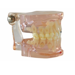 Modelo dental claro de dientes de edad mixta con caries - Product Image 1