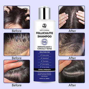 <span class=keywords><strong>Shampooing</strong></span> apaisant personnalisé au logo, anti-pelliculaire, traitement à l'acide salicylique pour la folliculite, le meilleur soin capillaire - Product Image 5