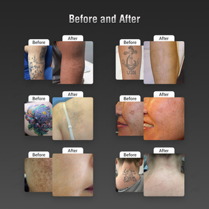 Macchina per la rimozione del tatuaggio portatile nd yag laser q switched - Product Image 6