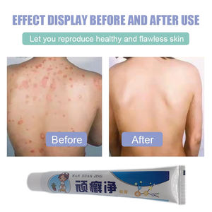 Травяной крем от зуда при лишае, экземе, псориазе, антибактериальная и противогрибковая мазь для тела - Product Image 4