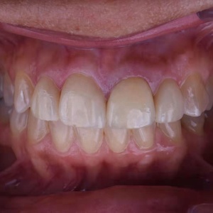 Blocco di <span class=keywords><strong>Zirconia</strong></span> Multistrato per Fresatura di Corone e Impianti Dentali Elettrici, Disco 3D Promax Kingch - Product Image 6