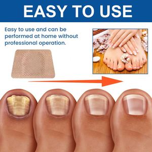 XIMONTH Soin des ongles Anti-fongique Naturel à base de plantes <span class=keywords><strong>Huile</strong></span> d'arbre à thé Ail Vitamine E Utilisation nocturne Traitement des champignons Patch pour les ongles - Product Image 5