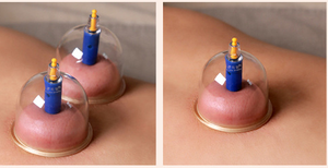 Juegos de terapia de ventosas, juegos de 24 tazas para celulitis, masaje con ventosas, alivio del dolor de espalda, ventosas chinas - Product Image 5