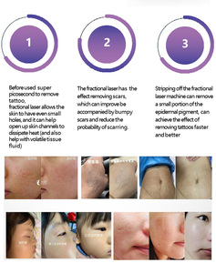 10600nm Co2 Fractional Laser Tattoo Remove <b>Machine</b> Vaginal Tightening Co2 Laser Co2 Laser <b>Engraving</b> <b>Machine</b> The Zixia Fairy - Product Image 5