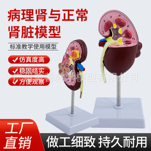 Simulation pédagogique de la structure et de l'anatomie du rein humain ; organes internes malades ; urologie ; glomerules ; néfons - Product Image 4