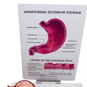 Modelo de Estómago con Estructura Patológica: Gastritis Atrofiada, Úlcera Perforada, Modelo de Sistema Digestivo Humano - Product Image 5
