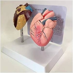 Modèle d'anatomie des organes humains, modèle de comparaison du cœur pathologique et du cœur sain chez les fumeurs - Product Image 5