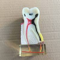Modelo Anatómico de Molar Patológico Dental de 4 Veces el Tamaño Real, Simulación de Perfil de Caries, Modelo de Enseñanza para Entrenamiento Dental