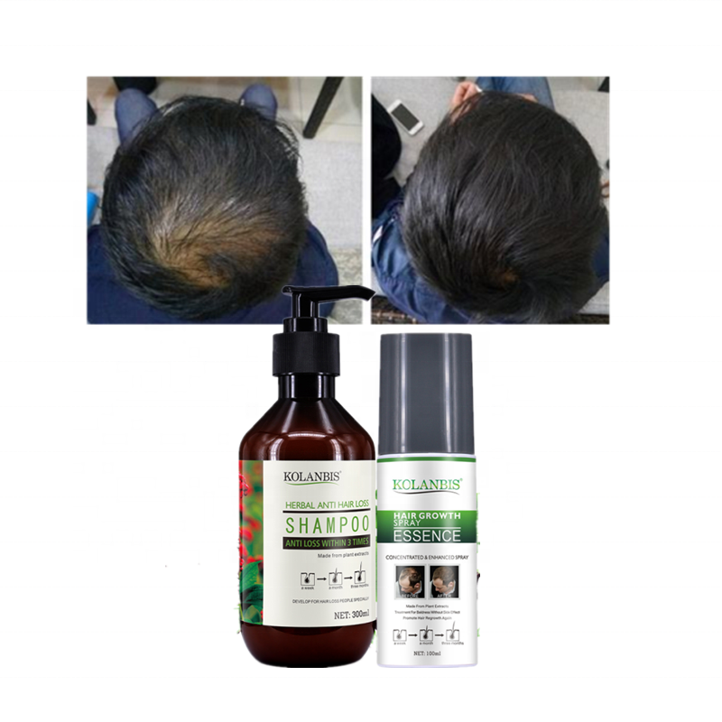 Лидер продаж, индивидуальные продукты для роста волос, шампунь и тоник для волос, Оптовая продажа